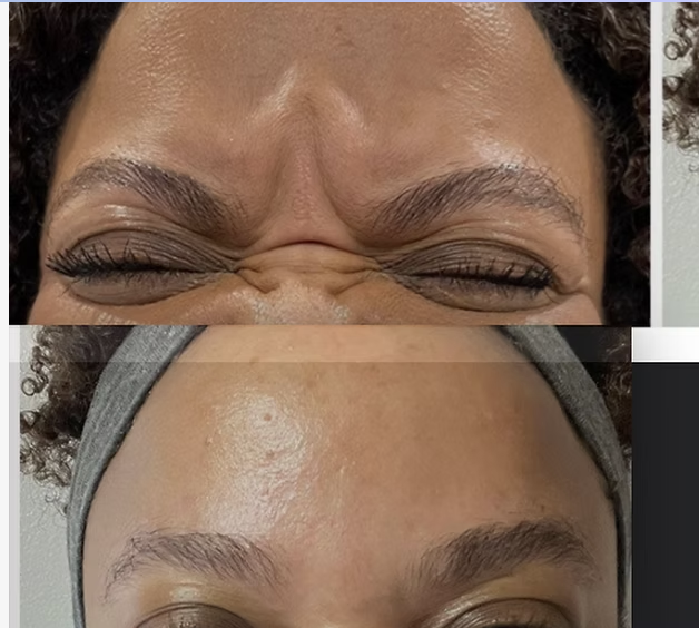 Botox before and after results
