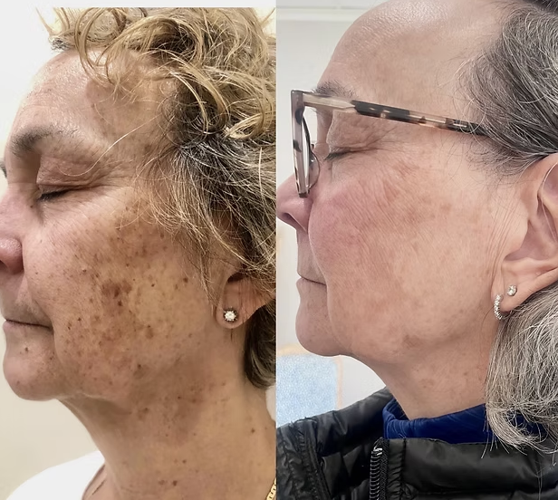 IPL / PhotoFacial before and after results