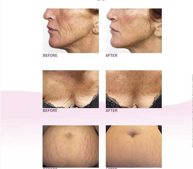 PRX-T33 Chemical Peel before and after results